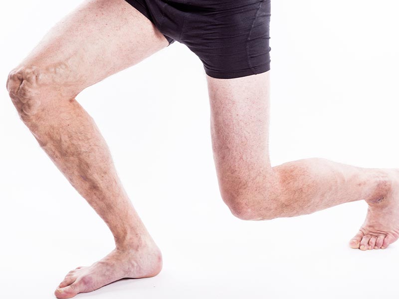 Calze elastiche per vene varicose