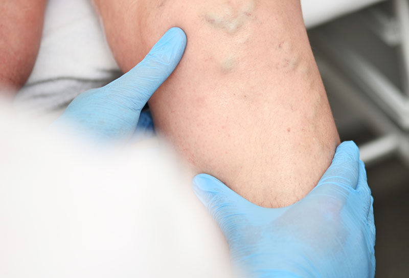 crema per vene varicose migliore